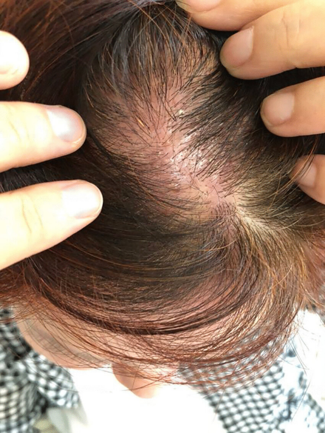 10 Reasons for Your Itchy Scalp